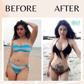 before-after photo abdominal-liposuction