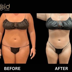 before-after photo abdominal-liposuction