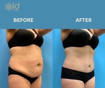 before-after photo vaser-liposuction