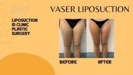 Before and after Vaser liposuction results at ID Clinic Bangkok, thigh contour improvement