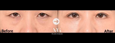 Результаты блефаропластики нижних век до и после в VG Plastic Surgery, уменьшение мешков