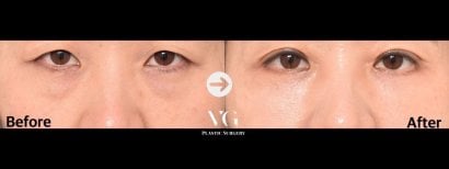 Результаты блефаропластики нижних век до и после в VG Plastic Surgery, уменьшение мешков