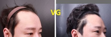 Результаты пересадки волос FUE до и после в VG Plastic Surgery, восстановление линии роста