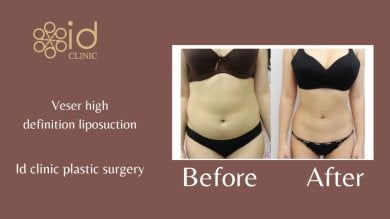 نتائج شفط الدهون فايزر قبل وبعد في ID Clinic Bangkok مع تحسين شكل الجسم