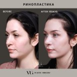 Resultados antes y después de eliminar la giba nasal en VG Plastic Surgery tras 10 días