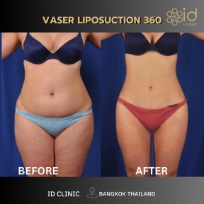 Результаты до и после VASER липосакции 360 в ID Clinic Bangkok, улучшение контура тела