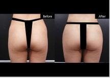Результаты липосакции до и после в VG Plastic Surgery – улучшенный контур тела