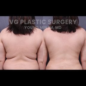 Результаты липосакции до и после в VG Plastic Surgery, видимое улучшение контура спины