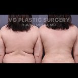 Результаты липосакции до и после в VG Plastic Surgery, видимое улучшение контура спины