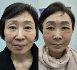 Результати до і після підтяжки обличчя в Seoul Miz Hospital (서울미즈병원), омолодження