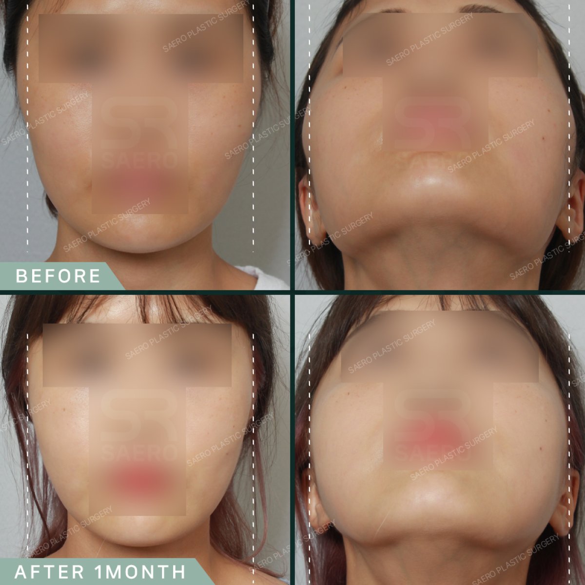 Resultados de contorno facial antes y después en SAERO Plastic Surgery, mejora de la mandíbula