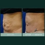 نتائج شد البطن قبل وبعد في SAERO Plastic Surgery، بطن أكثر نعومة بعد شهر
