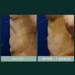 نتائج شد البطن قبل وبعد في SAERO Plastic Surgery، بطن مسطح بعد شهر واحد
