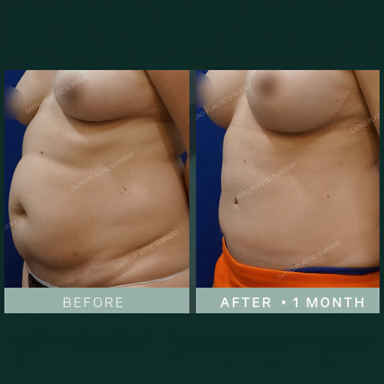 Resultados de abdominoplastia antes y después en SAERO Plastic Surgery – abdomen plano tras 1 mes