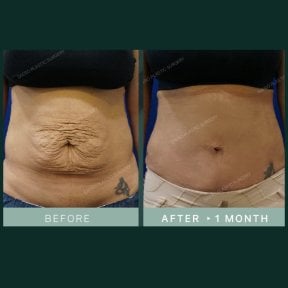 نتائج شد البطن في SAERO Plastic Surgery – بطن مسطح بعد شهر واحد