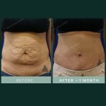 نتائج شد البطن في SAERO Plastic Surgery – بطن مسطح بعد شهر واحد