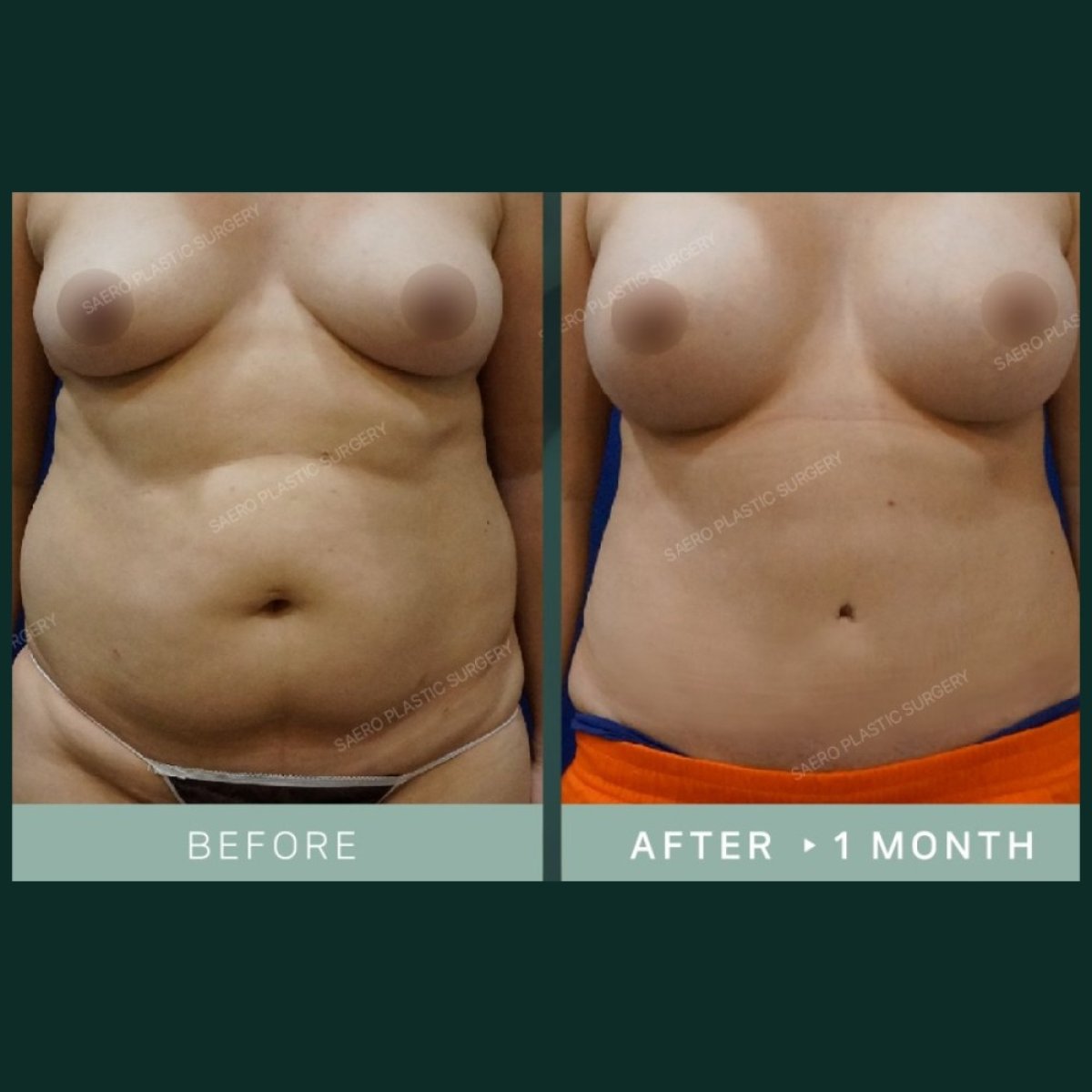 نتائج شد البطن والشفط قبل وبعد في SAERO Plastic Surgery، بطن أكثر تسطحًا