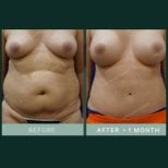 Результаты до и после абдоминопластики и липосакции в SAERO Plastic Surgery, плоский живот