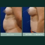 Результаты абдоминопластики и липосакции в SAERO Plastic Surgery, более плоский живот