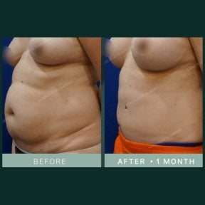 Результаты абдоминопластики и липосакции в SAERO Plastic Surgery, более плоский живот