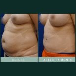 Результаты абдоминопластики и липосакции в SAERO Plastic Surgery, более плоский живот