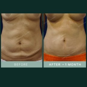 Результаты абдоминопластики и липосакции в SAERO Plastic Surgery, 1 месяц после