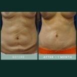 Результаты абдоминопластики и липосакции в SAERO Plastic Surgery, 1 месяц после