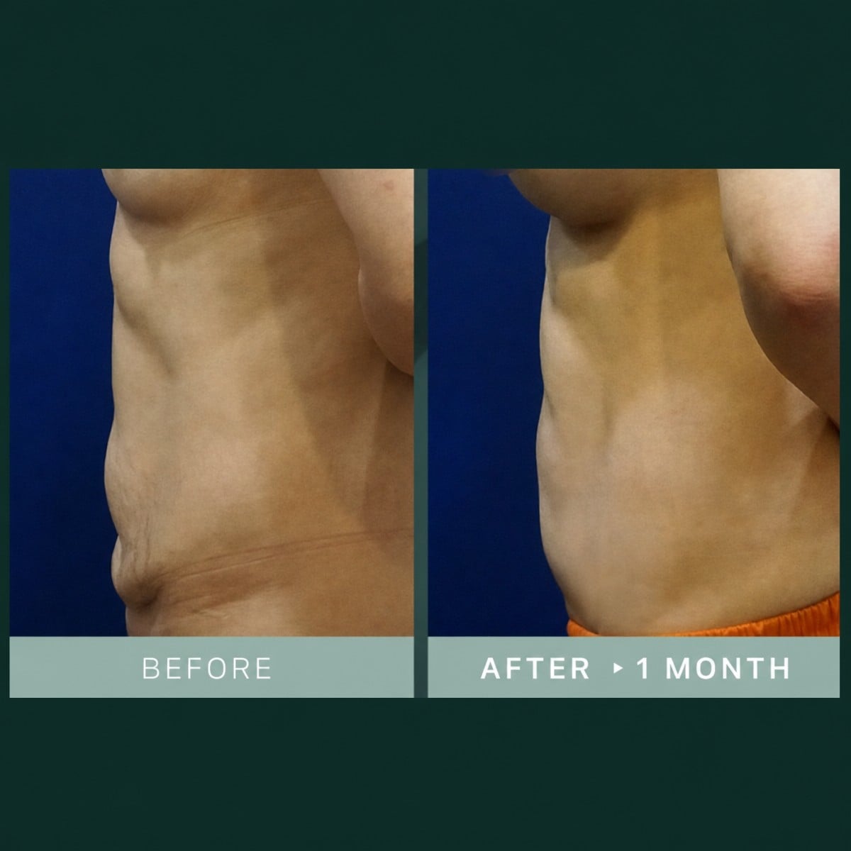 نتائج شد البطن والشفط في SAERO Plastic Surgery، بطن أكثر تسطحًا