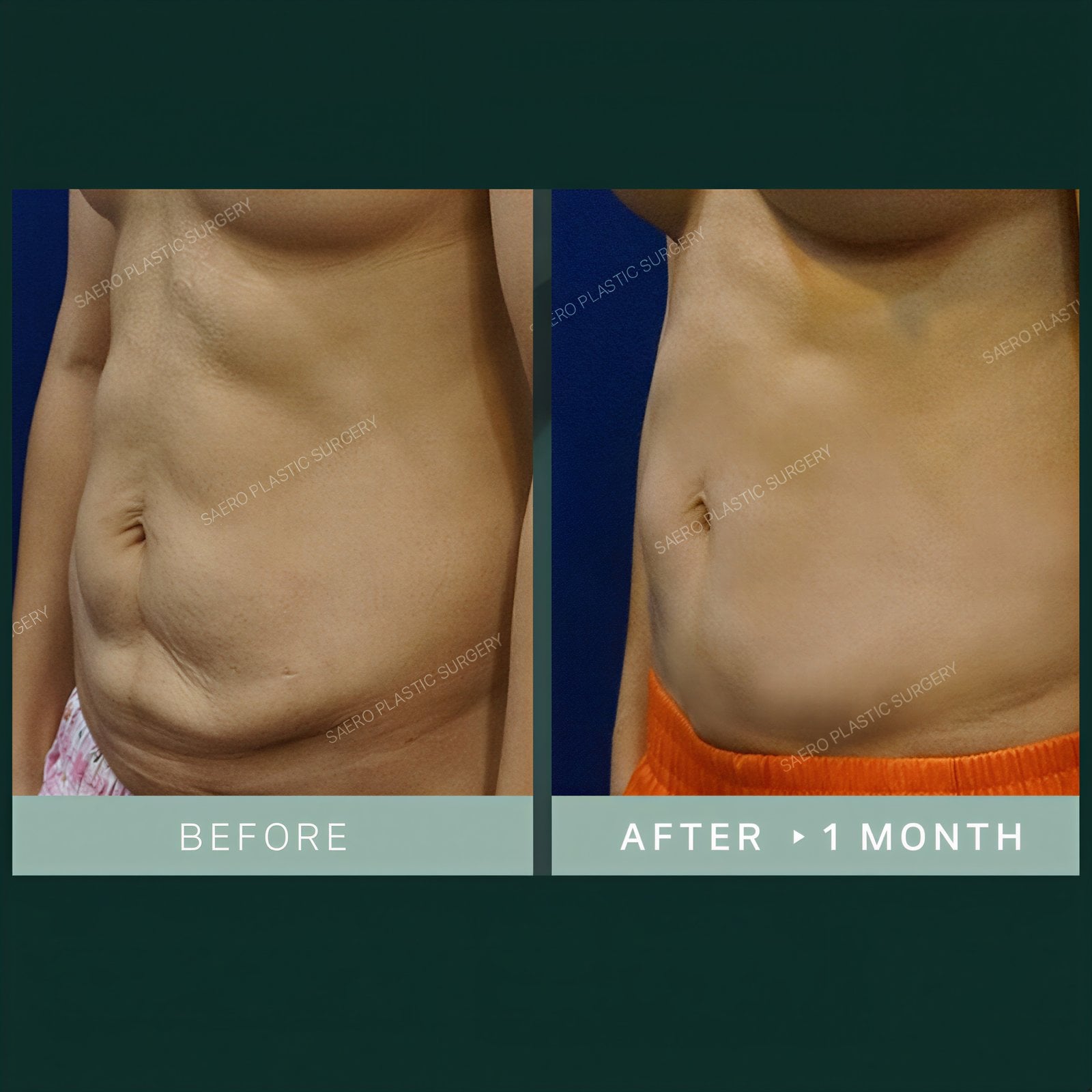 Resultados de abdominoplastia y liposucción en SAERO Plastic Surgery, 1 mes después