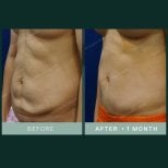 Результаты абдоминопластики и липосакции в SAERO Plastic Surgery, 1 месяц после