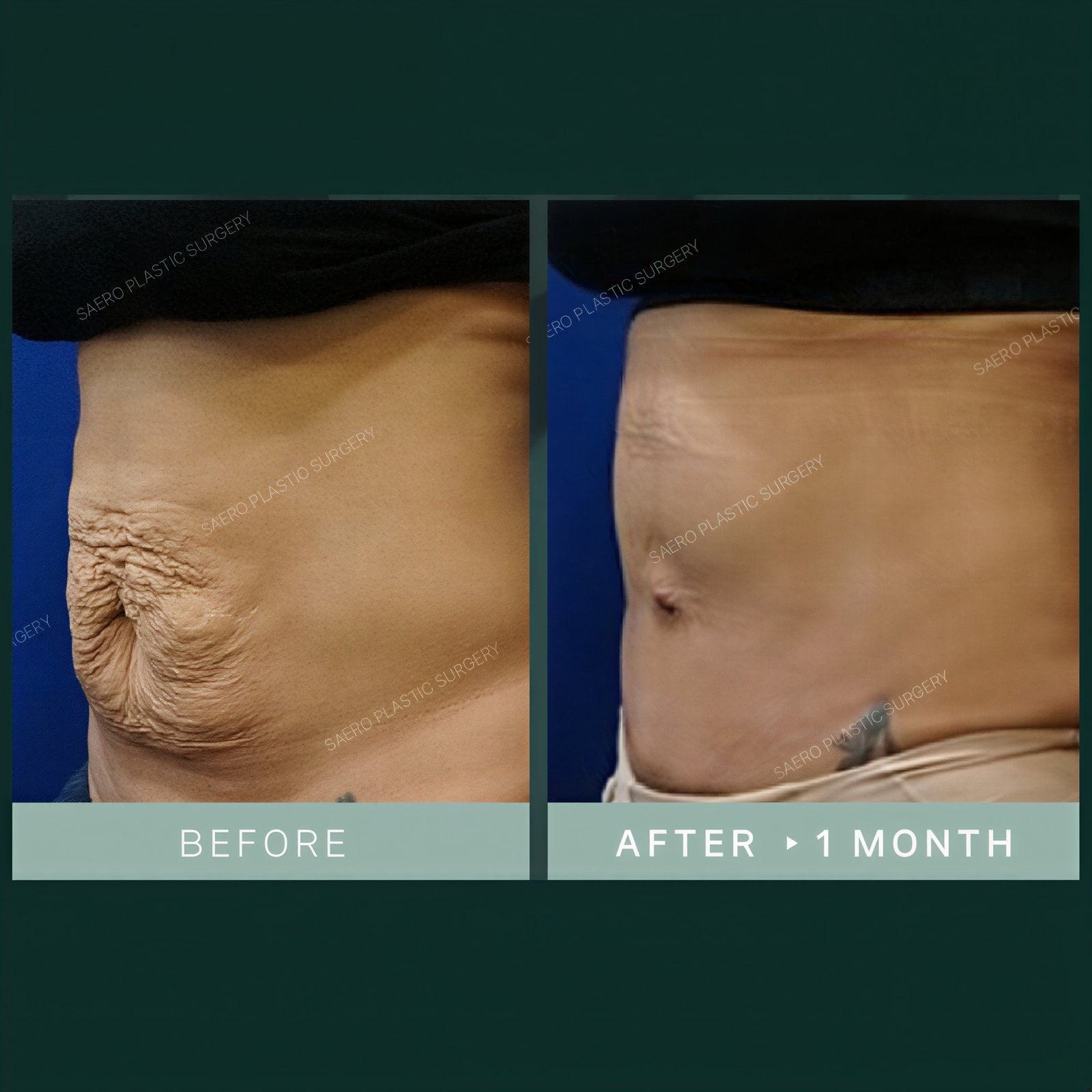 Resultados de abdominoplastia antes y después en SAERO Plastic Surgery, abdomen liso tras 1 mes