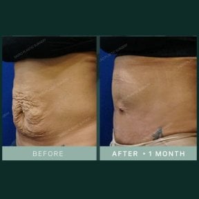Результаты абдоминопластики до и после в SAERO Plastic Surgery, гладкий живот через месяц