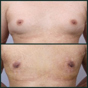 نتائج قبل وبعد جراحة التثدي في SAERO Plastic Surgery، تحسين شكل صدر الرجل