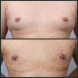 نتائج قبل وبعد جراحة التثدي في SAERO Plastic Surgery، تحسين شكل صدر الرجل