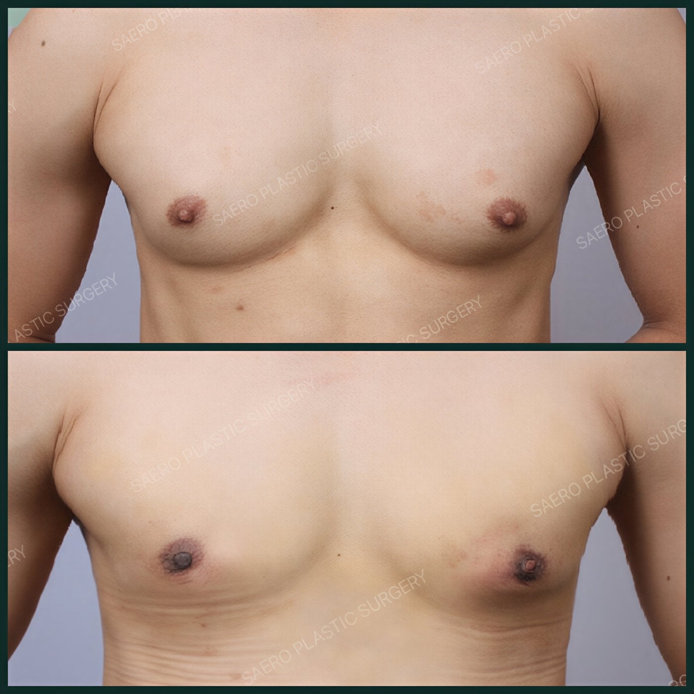 Resultados antes y después de cirugía de ginecomastia en SAERO Plastic Surgery, contorno masculino