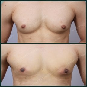 نتائج قبل وبعد جراحة التثدي في SAERO Plastic Surgery، تحسين شكل صدر الرجل