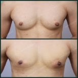 نتائج قبل وبعد جراحة التثدي في SAERO Plastic Surgery، تحسين شكل صدر الرجل