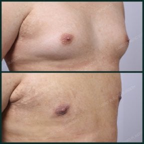نتائج قبل وبعد جراحة التثدي في SAERO Plastic Surgery، تحسين شكل صدر الرجل