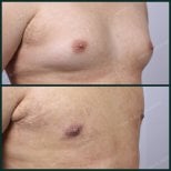 نتائج قبل وبعد جراحة التثدي في SAERO Plastic Surgery، تحسين شكل صدر الرجل