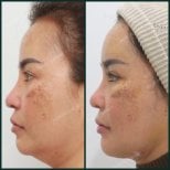 Resultado de liposucción de papada antes y después en SAERO Plastic Surgery, línea mandibular mejorada