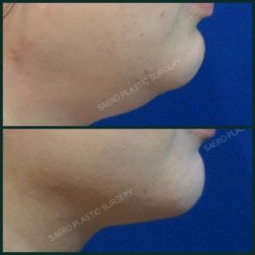 Resultados de liposucción de papada antes y después en SAERO Plastic Surgery, línea de mandíbula mejorada