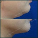 Resultados de liposucción de papada antes y después en SAERO Plastic Surgery, línea de mandíbula mejorada