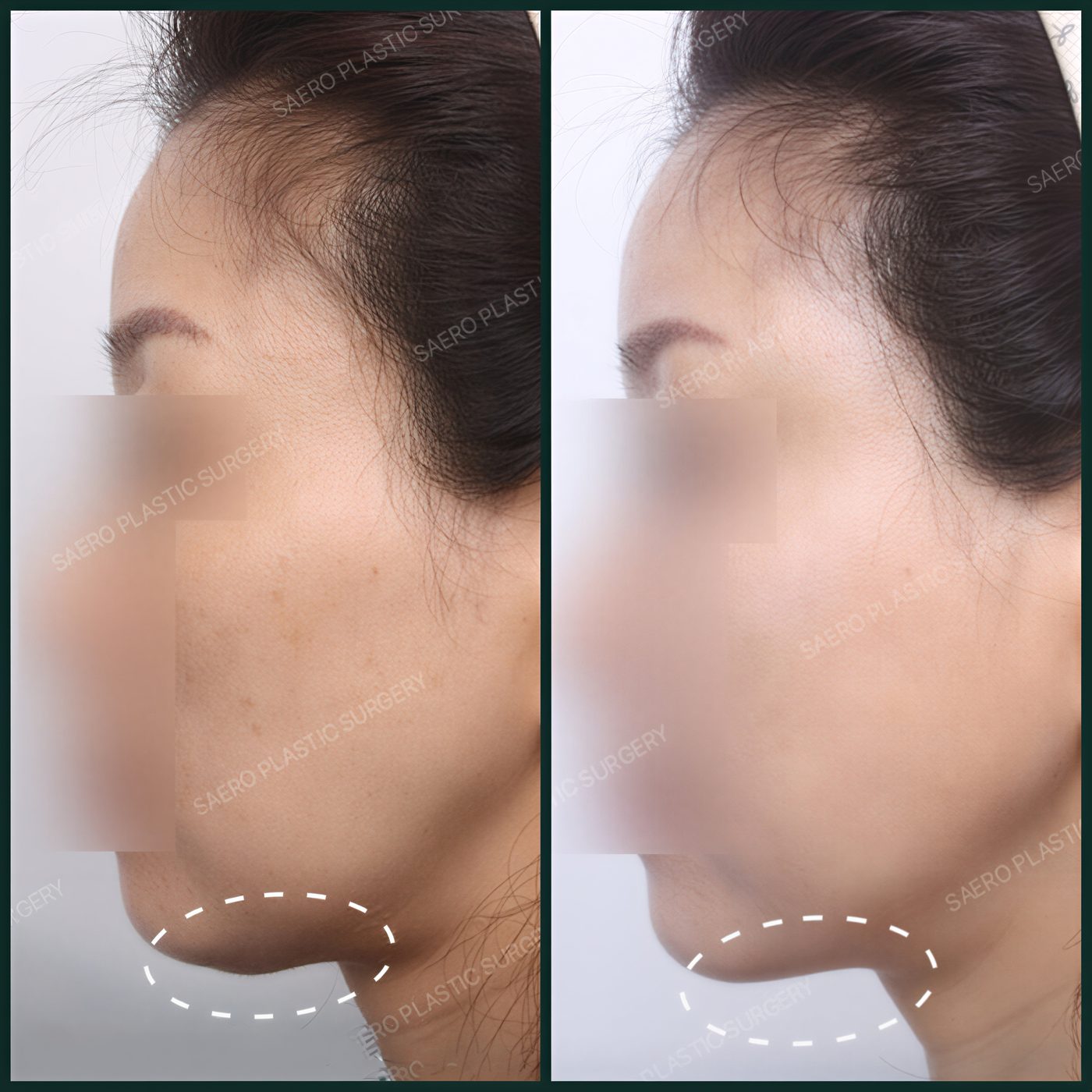 نتائج شفط دهون الذقن المزدوج قبل وبعد في SAERO Plastic Surgery، تحسين خط الفك