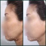 Resultados de liposucción de papada antes y después en SAERO Plastic Surgery, línea de mandíbula mejorada