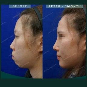 نتائج تحديد ملامح الوجه قبل وبعد في SAERO Plastic Surgery، تحسين خط الفك