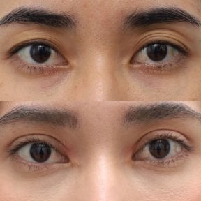 Before and after droopy eyelid surgery results at Wansiri Hospital, improved eyelid appearance