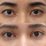 Before and after droopy eyelid surgery results at Wansiri Hospital, improved eyelid appearance
