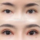 Before and after droopy eyelid surgery results at Wansiri Hospital, improved eyelid appearance