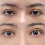 Before and after droopy eyelid surgery results at Wansiri Hospital, improved eyelid appearance