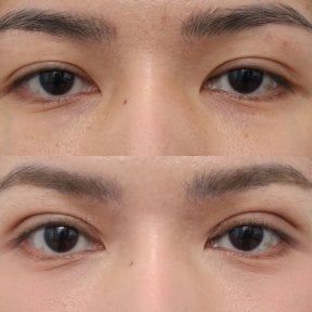 Before and after droopy eyelid surgery results at Wansiri Hospital, improved eyelid appearance